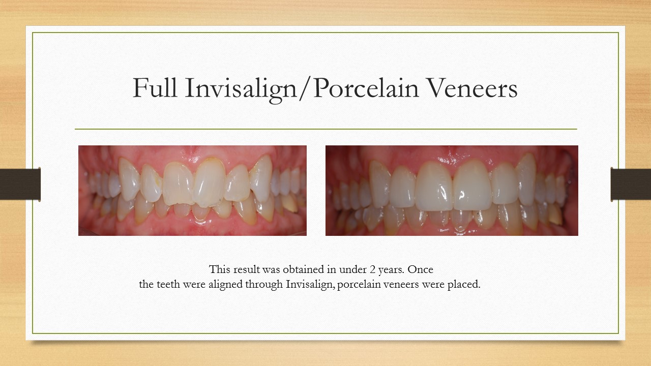 Kenneth W. Arida, DDS, PC | LANAP reg , Dental Fillings and Oral Cancer Screening