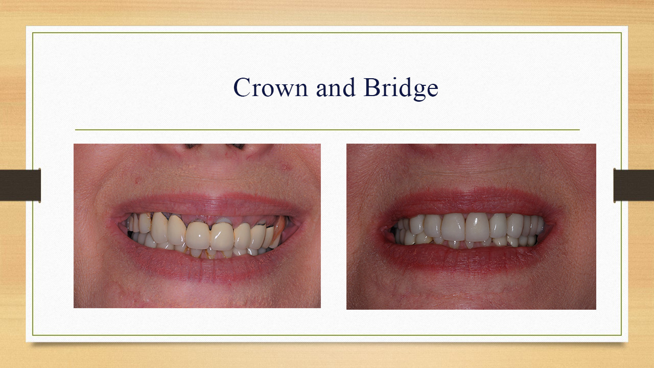 Kenneth W. Arida, DDS, PC | Crowns  amp  Caps, Dental Bridges and TMJ Disorders