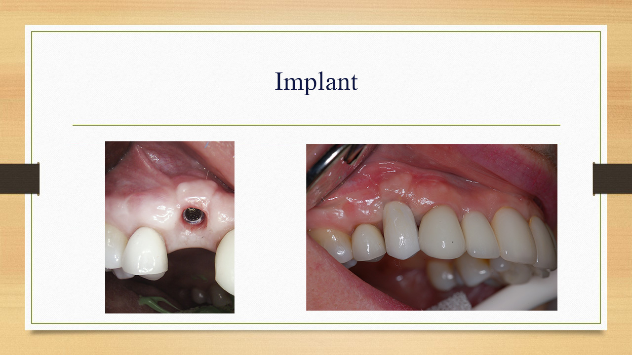 Kenneth W. Arida, DDS, PC | Dentures, Sports Mouthguards and All-on-4®