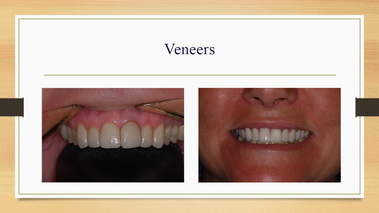 Kenneth W. Arida, DDS, PC | Implant Dentistry, Crowns & Caps and Invisalign®