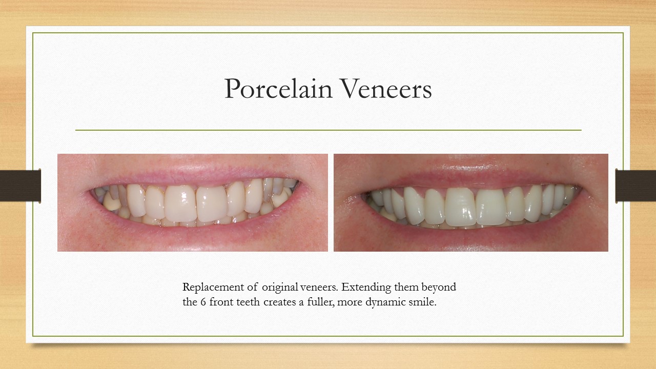 Kenneth W. Arida, DDS, PC | Crowns  amp  Caps, Teeth Whitening and Night Guards