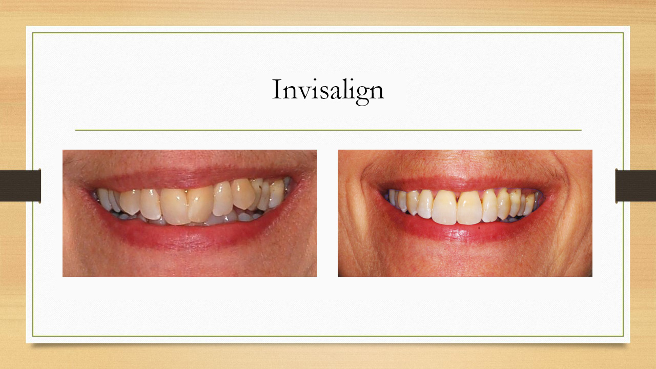invisalign